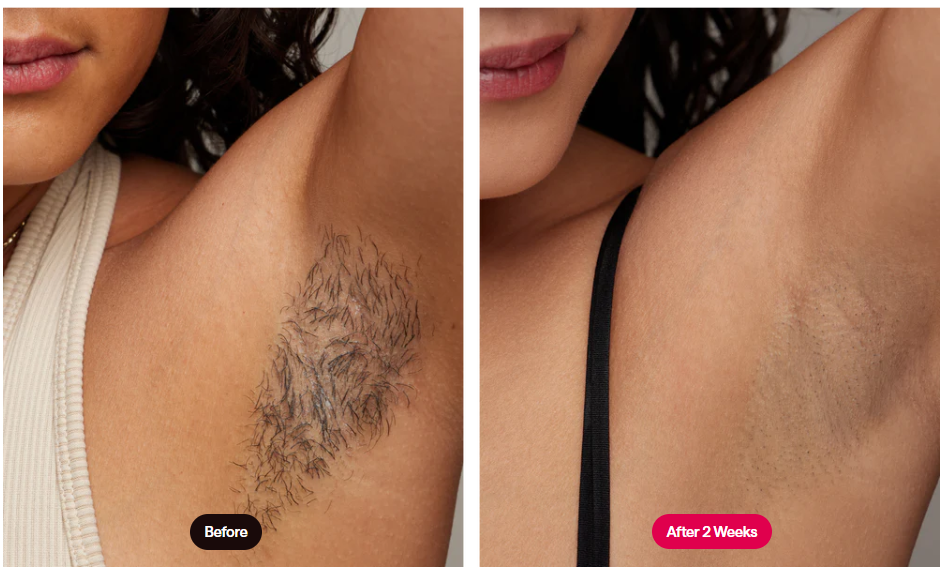 Ulike Air 10 Results on Armpit