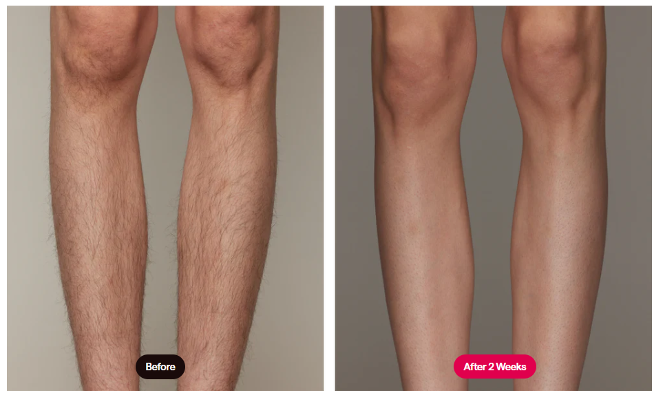 Ulike Air 10 IPL Hair Removal Results on Legs