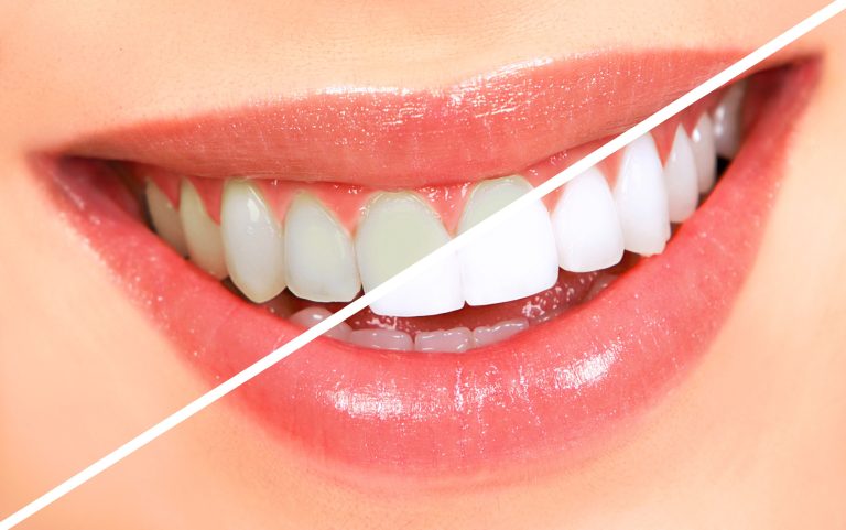 The 5 Best Teeth Whitening Kits to Buy