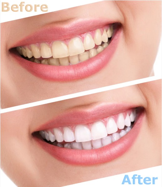 Auraglow Teeth Whitening Kit Smile